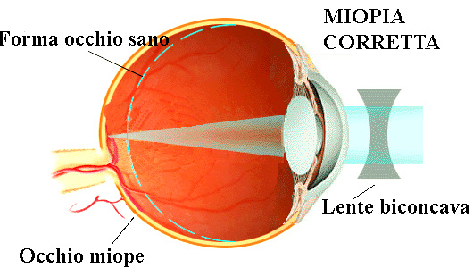 miopia retina