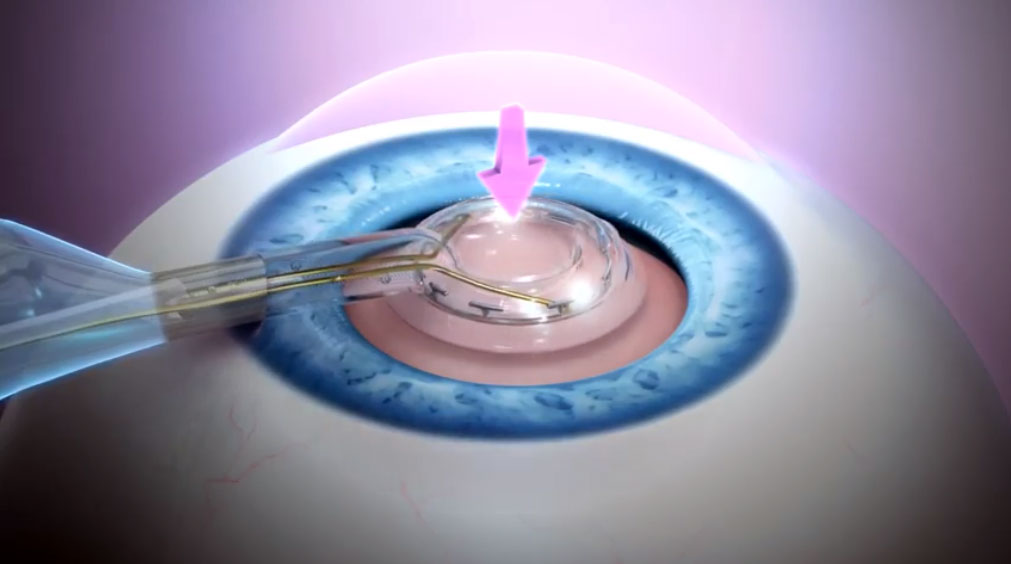 Zepto® Precision Cataract Surgery